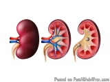Kidney Stone Relief with Trusted Homeopathy Doctor in Noida