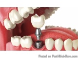 Advanced Dental Implants in Chennai | Illume Dental Clinic