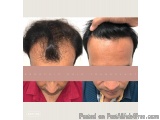 Hair Transplant in Indore | Safe, Natural & Permanent Hair Restoration