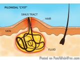 The image is a cross-section of a skin, showing the process of Pilonidal "Cyst" sinus tract. The sinus is a type of hair foll...