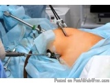 Laparoscopic Hernia Surgery in Kolkata
