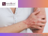 Get Expert Skin Psoriasis Treatment in Bangalore - Dermaqure