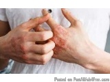 The image shows a person's hands, specifically their hands, with red, inflamed skin on their palms. The skin appears to be sw...