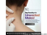 Moles & Warts Removal in Darbhanga | Safe Care with Laser Skin Clinic