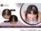 Effective Alopecia Solutions in Bangalore - Dermaqure
