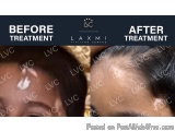 The image is a before and after comparison of a hair transplant procedure. On the left side of the image, there is a close-up...