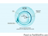 The image is a diagram that shows the process of an ICSI (ICSI) injection in the egg cytoplasm. The diagram is divided into t...