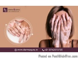 Best Vitiligo Specialist in Bangalore for Advanced Skin Care - Dermaqure Skin and Cosmetology Clinic