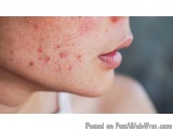 The image is a close-up of a person's face, specifically their upper lip and neck. The person appears to be in their late twe...