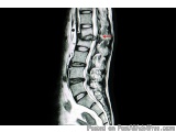 The image is a black and white MRI scan of the cervical spine. The scan is a cross-sectional view of the spine, showing the v...