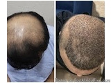 The image is a side-by-side comparison of a person's head before and after a hair transplant procedure. On the left side, the...