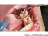 Root Canal Treatment in Chennai | Advanced Endodontic Care at Illume Advanced Dentistry