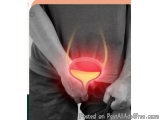 Prostate Cancer Specialists For Advanced Cancer Diagnosis And Tre...