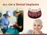 The image is an advertisement for all-on-6 dental implants. It features a group of dental professionals working together to r...