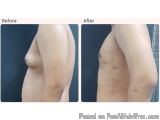 Gynecomastia Surgery Cost In Delhi - Dr Rajat Gupta