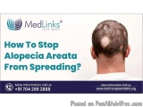 How To Stop Alopecia Areata From Spreading? | Hair Transplant in Delhi