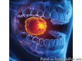 The image is a 3D rendering of a human skull with a red and yellow cancer cell in the middle of its mouth. The cancer cell is...