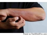 The image shows a close-up of a person's arm. The person is wearing a black t-shirt and their hand is visible in the foregrou...
