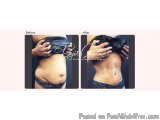 Latest Tummy Tuck Surgery Techniques Available Today