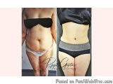 Virtual Consultations For Tummy Tuck Surgery: What You Need To Kn...