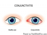The image is a comparison between two types of conjunctivitis. On the left side of the image, there is a pair of blue eyes wi...