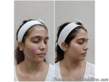 Best Acne Treatment in Thane at DNA Royal Aesthetic Clinic | Advanced Skin Care Solutions