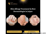 Skin Allergy Treatment by Best Dermatologist in Jaipur