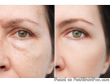 The image is a side-by-side comparison of a woman's face before and after treatment. On the left side, the woman's eyes are v...