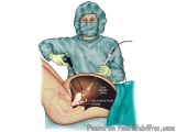 The image shows a person wearing a blue surgical gown, a face mask, and gloves, performing an operation on a patient's stomac...