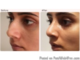 Rhinoplasty Surgery In Delhi - Dr Rajat Gupta