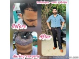 The image is a before and after comparison of a man's hair transplant procedure. On the left side of the image, there is a ph...