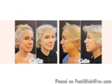 Schedule Facelift Surgery Consultation with Certified Surgeons