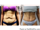 Tummy Tuck Surgery Cost In Delhi - Dr Rajat Gupta