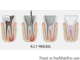 The image is a cross-section of a tooth, showing the process of a R.C.T. process. It consists of three stages of the process,...