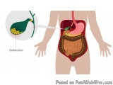 Expert Homeopathic Treatment for Gallbladder Stone in Noida