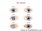 The image is a set of six illustrations of different types of eye diseases. Each illustration is a close-up of a human eye, s...