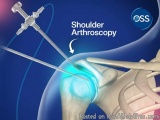 Shoulder Replacement Surgery In Delhi Ncr: Advanced Care For Pain...