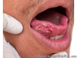 Best Mouth Cancer Doctor in Ahmedabad