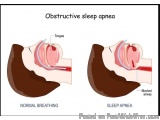 Sleep Apnea Treatment Specialist in Jaipur – Dr. Virendra Singh