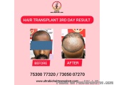 Dandruff Treatment In Chennai