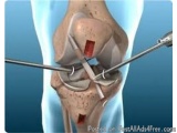 The image shows a 3D illustration of a knee joint with a surgical instrument attached to it. The instrument appears to be a s...