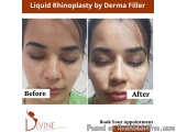 Rhinoplasty Surgery In Delhi ~p~ Best Nose Surgeon