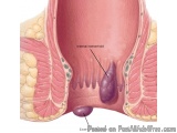 The image is a cross-section of a human body, specifically the internal hemorrhoid. The image is labeled with the names of th...