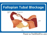 fallopian tubal blockage treatment