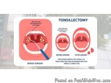 The image is an infographic that explains the process of Tonsillectomy. It is divided into two sections. The first section on...