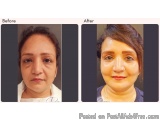 Eyelid Surgery In Delhi - Dr Rajat Gupta
