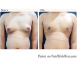 Gynecomastia Surgery Cost In Delhi - Dr Rajat Gupta