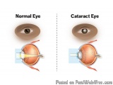 Cataract Eye Surgery In Delhi - Dr Anisha Gupta