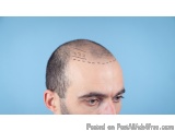 No.1 Hair Transplant Clinic In Thane At Dna Royal: Understanding...