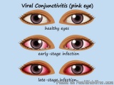 Clear Your Eyes with Homeopathic Conjunctivitis Treatment